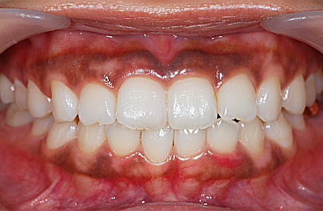 ガムピーリング