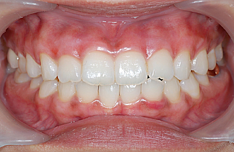 ガムピーリング