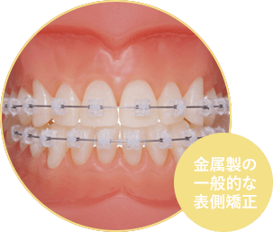 一般的な歯科矯正、マルチブラケット