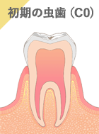 初期の虫歯