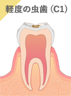 軽度の虫歯