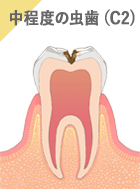 中程度の虫歯