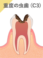 重度の虫歯