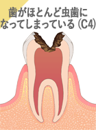 歯がほとんど虫歯になってしまっている