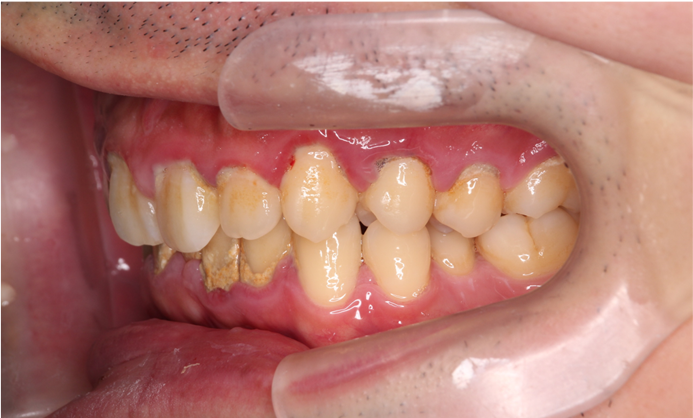 歯周病治療前後